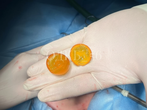 операция ребенок шарик